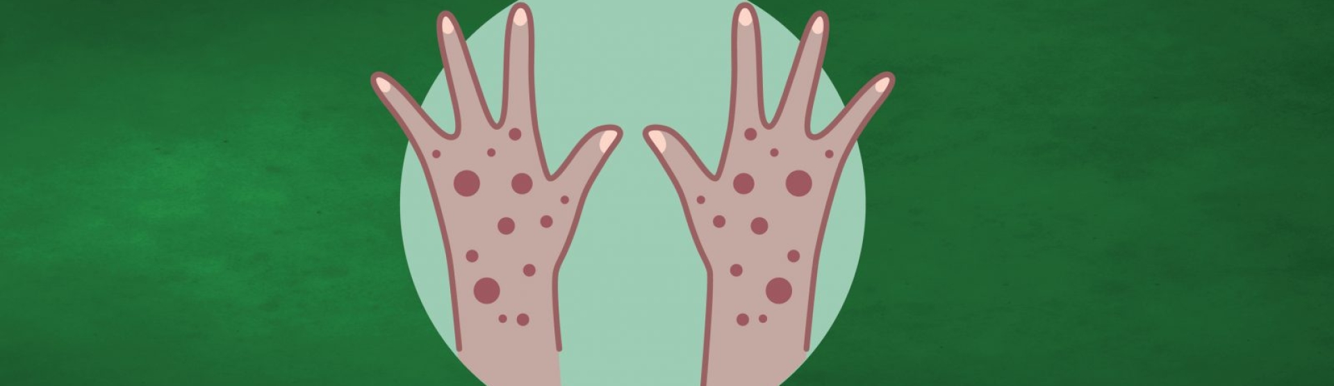 NON, le vaccin contre la Mpox ne contient pas de "puce de traçage" et ne rend pas stérile