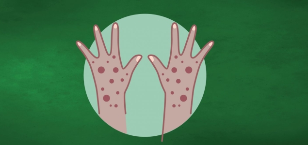 NON, le vaccin contre la Mpox ne contient pas de "puce de traçage" et ne rend pas stérile