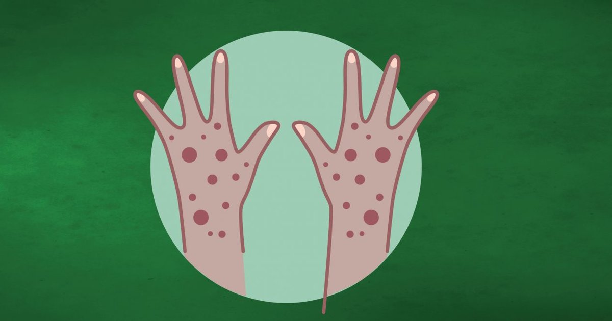 Riposte contre la Mpox